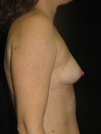 Natural Fill Breast Augmentation 487258
