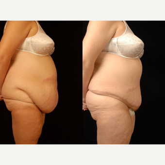 45-54 year old woman treated with Panniculectomy after 3663650
