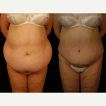 45-54 year old woman treated with Panniculectomy before 3663650