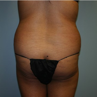 Brazilian Butt Lift before 3667635