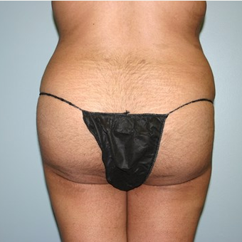 Brazilian Butt Lift after 3667635