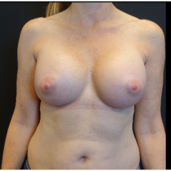 35-44 year old woman treated with Mentor Breast Implants after 3529813