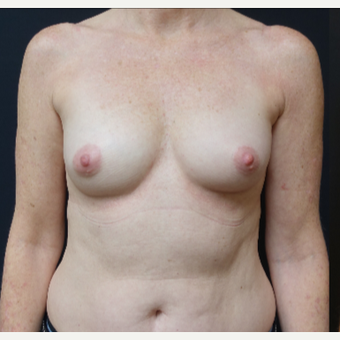 35-44 year old woman treated with Mentor Breast Implants before 3529813