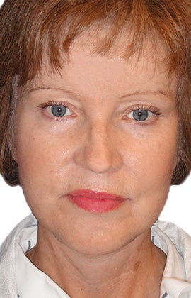 Facelift, Neck lift, Browlift, Lower Blepharoplasty (eyelid lift) after 319194