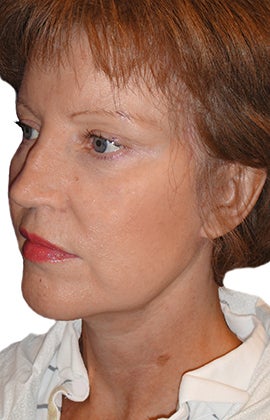 Facelift, Neck lift, Browlift, Lower Blepharoplasty (eyelid lift) 319194