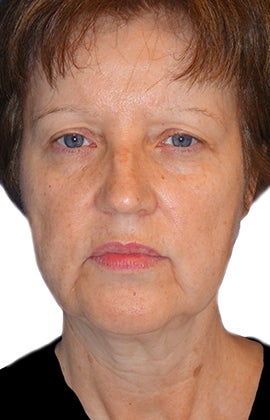 Facelift, Neck lift, Browlift, Lower Blepharoplasty (eyelid lift) before 319194