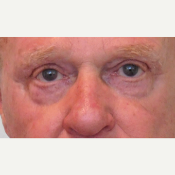 65-74 year old man treated with Eyelid Surgery after 3124308