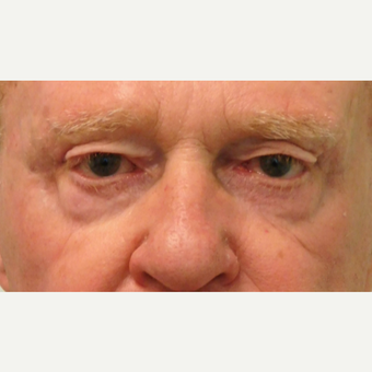 65-74 year old man treated with Eyelid Surgery before 3124308