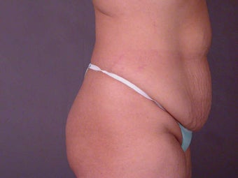 Tummy Tuck before 280144