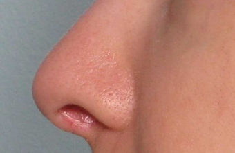 Juvederm after 460603