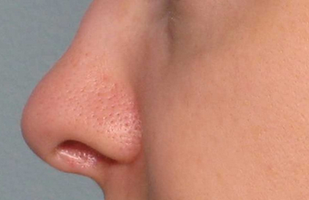 Juvederm before 460603