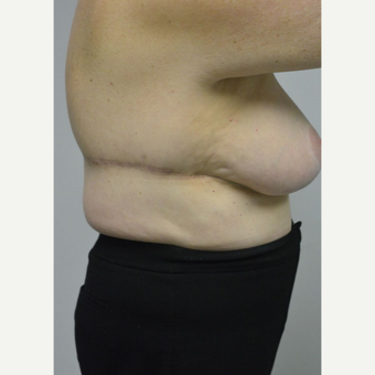 65-74 year old woman treated with Upper Body Lift/ Bra Line Back Lift after 3850418