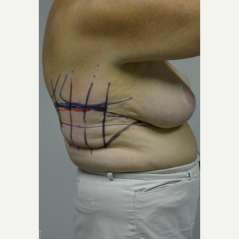 65-74 year old woman treated with Upper Body Lift/ Bra Line Back Lift before 3850418