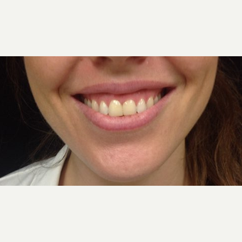 25-34 year old woman treated with 3 units Botox for Gummy Smile before 3744778