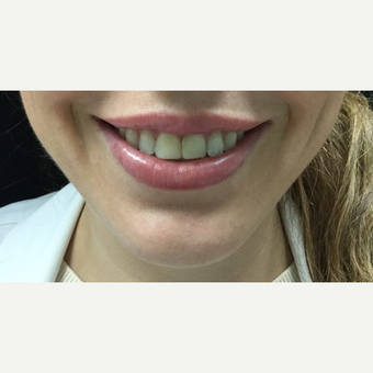 25-34 year old woman treated with 3 units Botox for Gummy Smile after 3744778