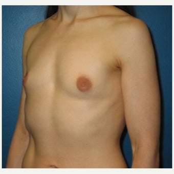 Silicone implant breast augmentation on 30 year old patient 1755745