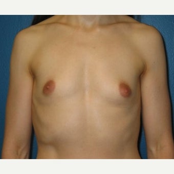 Silicone implant breast augmentation on 30 year old patient before 1755745