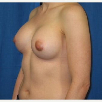 Silicone implant breast augmentation on 30 year old patient 1755745
