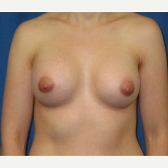 Silicone implant breast augmentation on 30 year old patient after 1755745