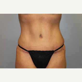 35-44 year old woman treated with Tummy Tuck after 3529098
