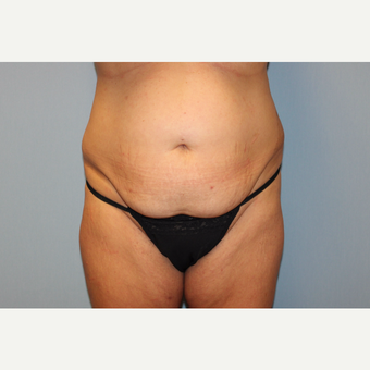 35-44 year old woman treated with Tummy Tuck before 3529098