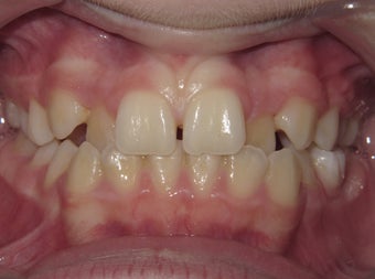 Teen Orthodontic treatment with braces before 1420774