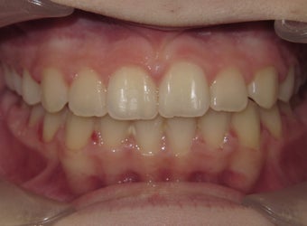 Teen Orthodontic treatment with braces after 1420774