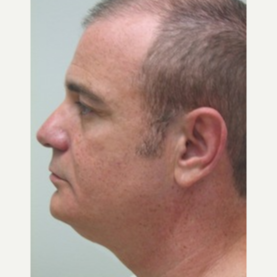 35-44 year old man treated with Non Surgical Face Lift before 3137282