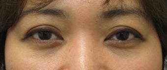 Eyelid retraction repair in thyroid disease by CO2 laser after 259541