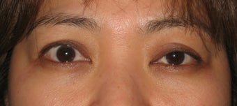 Eyelid retraction repair in thyroid disease by CO2 laser before 259541