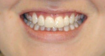 Adult Orthodontics with Clear Braces after 3659929