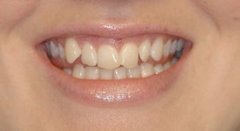 Adult Orthodontics with Clear Braces before 3659929