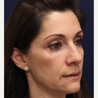 35-44 year old woman treated with Bellafill before 3143415