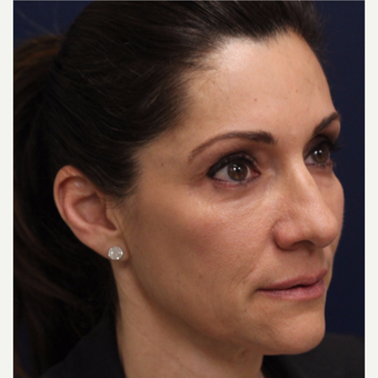 35-44 year old woman treated with Bellafill after 3143415