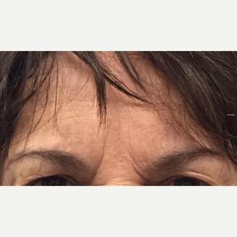 65-74 year old woman treated with Brow Lift before 3840932