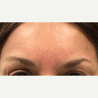 65-74 year old woman treated with Brow Lift after 3840932