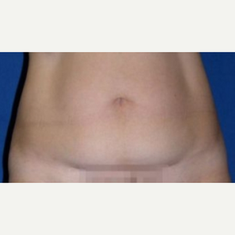 55-64 year old woman treated with Tummy Tuck before 3009859