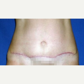 55-64 year old woman treated with Tummy Tuck after 3009859