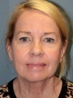 55-64 year old woman treated with Neck Lift before 3103903