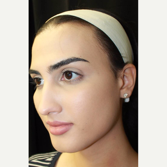 18-24 year old female treated with Facial Feminization Surgery before 2747180