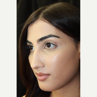 18-24 year old female treated with Facial Feminization Surgery after 2747180