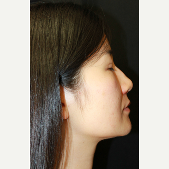 18-24 year old woman treated with Asian Rhinoplasty before 3741617