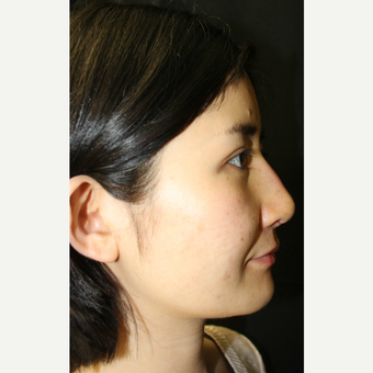 18-24 year old woman treated with Asian Rhinoplasty after 3741617