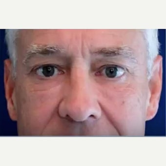 55-64 year old man treated with Bellafill after 2437862
