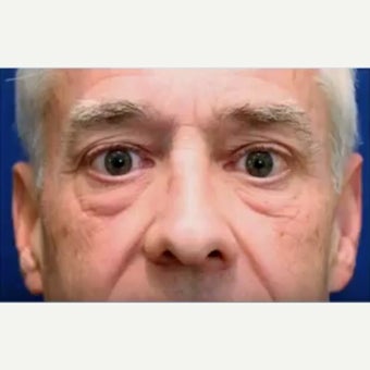 55-64 year old man treated with Bellafill before 2437862