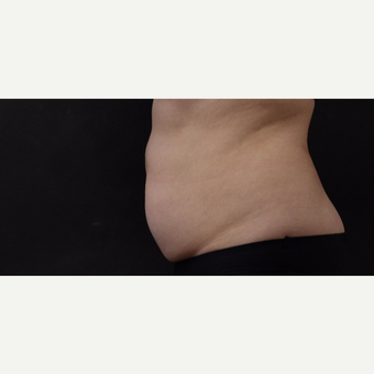 55 year old woman treated with CoolSculpting before 3220713