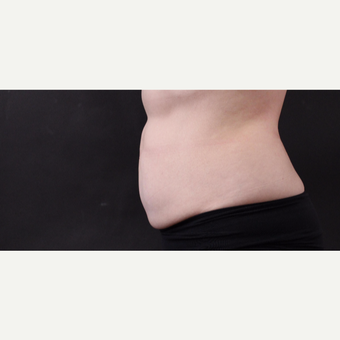 55 year old woman treated with CoolSculpting after 3220713
