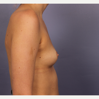 18-24 year old woman treated with Breast Augmentation before 3494791