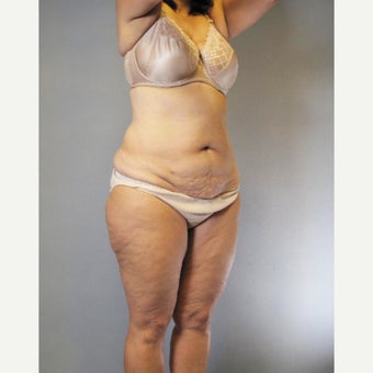 55-64 year old woman treated with Tummy Tuck 1709502