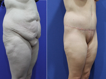Body Lift after 1388948
